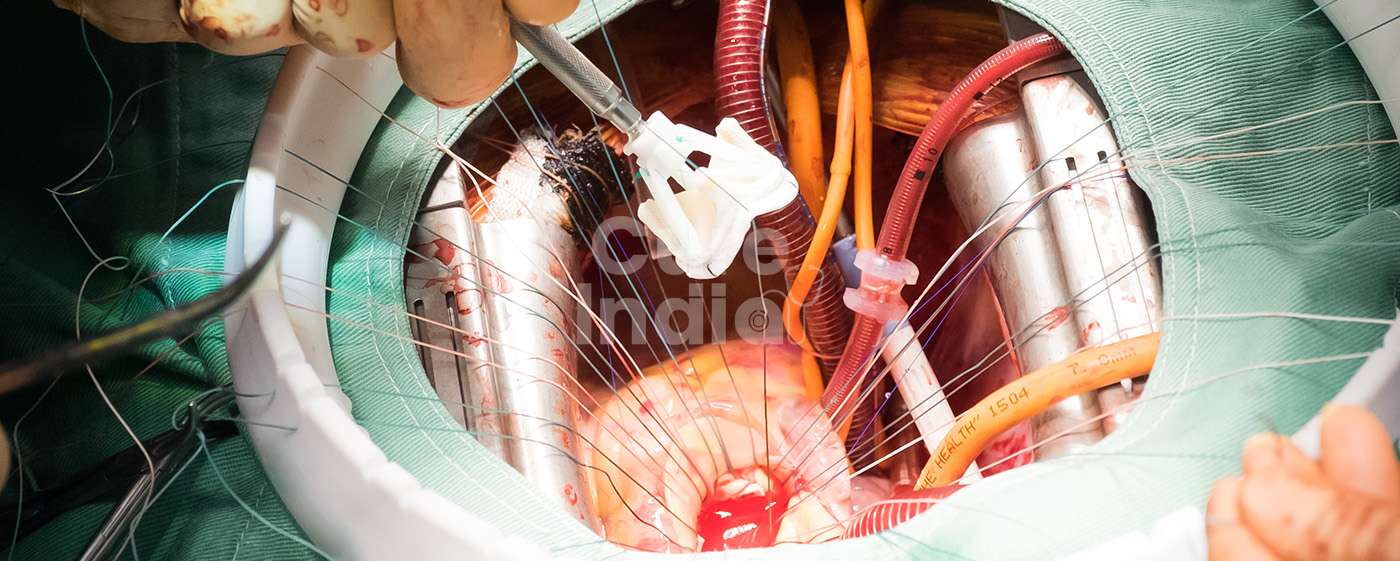 অর্টিক ভালভ প্রতিস্থাপন